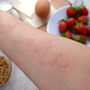 Food Allergies 101: Identifying Culprits in Your Diet