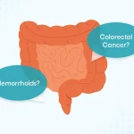 Hemorrhoids vs colorectal cancer difference