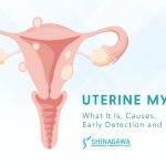 Uterine Myoma: What It Is, Causes, Prevention, and Treatment Options