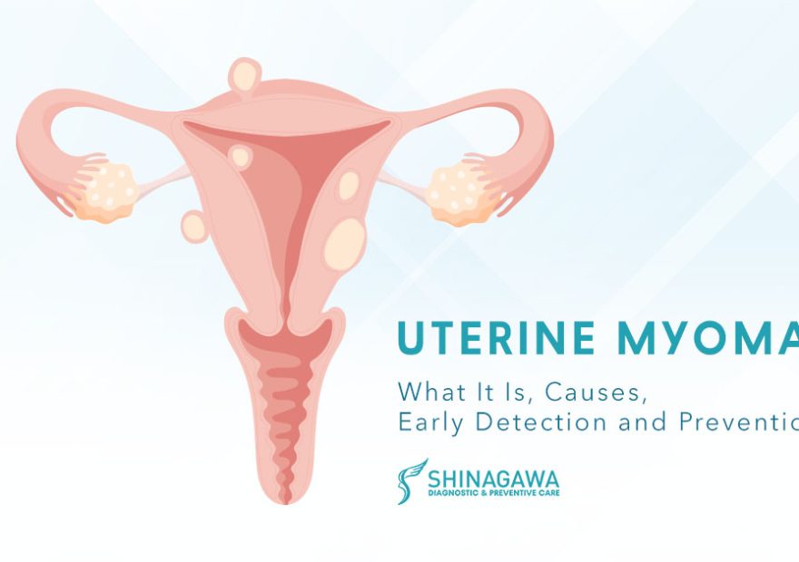 Uterine Myoma: What It Is, Causes, Prevention, and Treatment Options