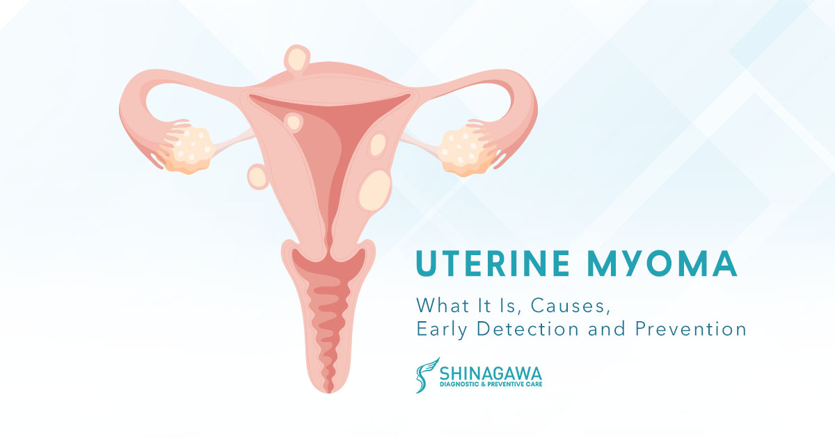 Uterine Myoma: What It Is, Causes, Prevention, and Treatment Options